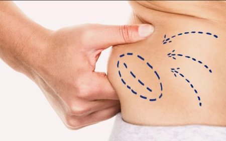 Liposuction Recovery Roadmap Advice from Best Liposuction Surgeons in Dubai