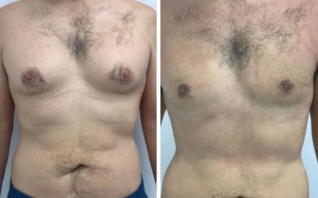 The Best Aftercare for Gynecomastia Surgery in Dubai