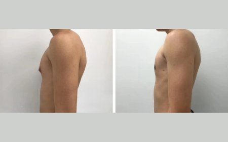 Why I Chose Dubai for My Gynecomastia Treatment