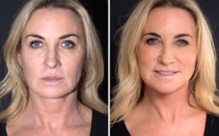 Thread Lift Treatment in Dubai for the Eyes: Lift, Tighten, and Rejuvenate