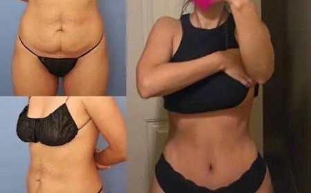 The Healing Journey: What Happens After a Tummy Tuck in Dubai