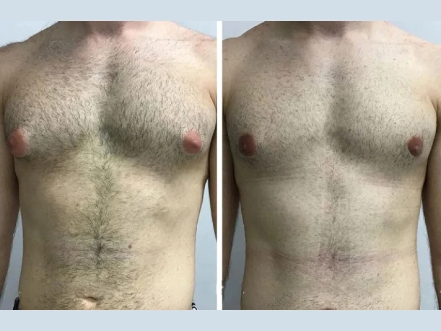 Post-Surgery Life: Living Confidently After Gynecomastia in Dubai