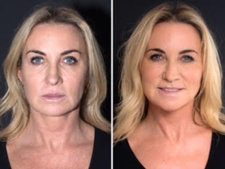 Thread Lift Treatment in Dubai for the Eyes: Lift, Tighten, and Rejuvenate