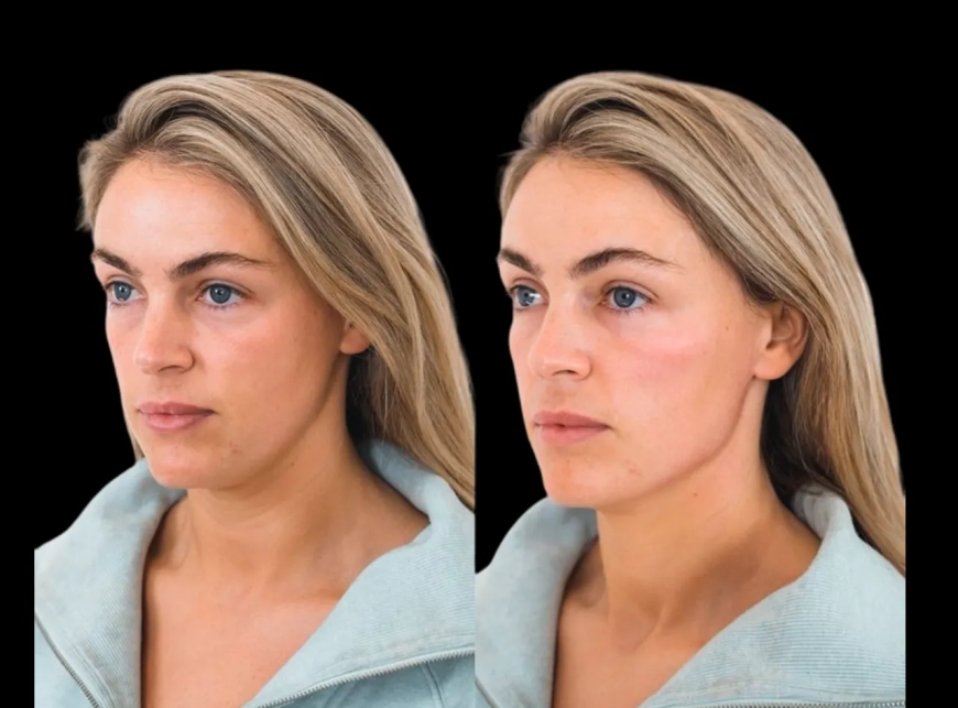 What Makes the Best Doctors in Dubai Stand Out in the Cheek Fillers Industry?