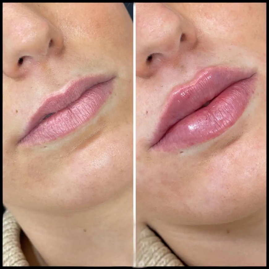 Top Tips for Preparing for Russian Lip Fillers with the Best Doctors in Dubai