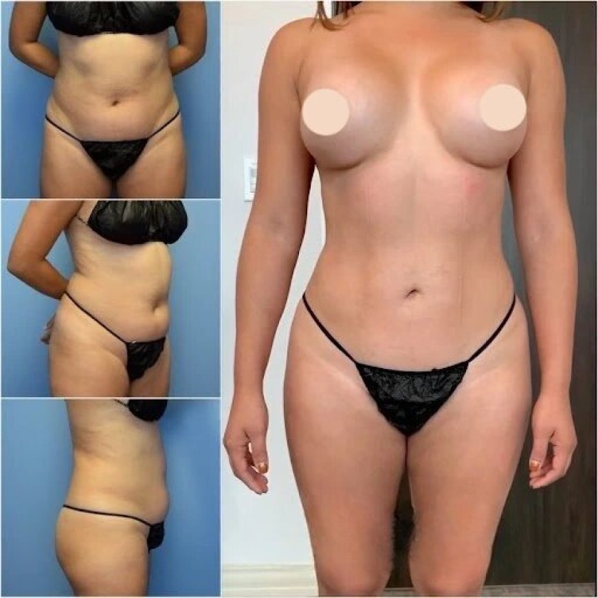 Why You Should Choose Body Contouring in Dubai for Your Transformation