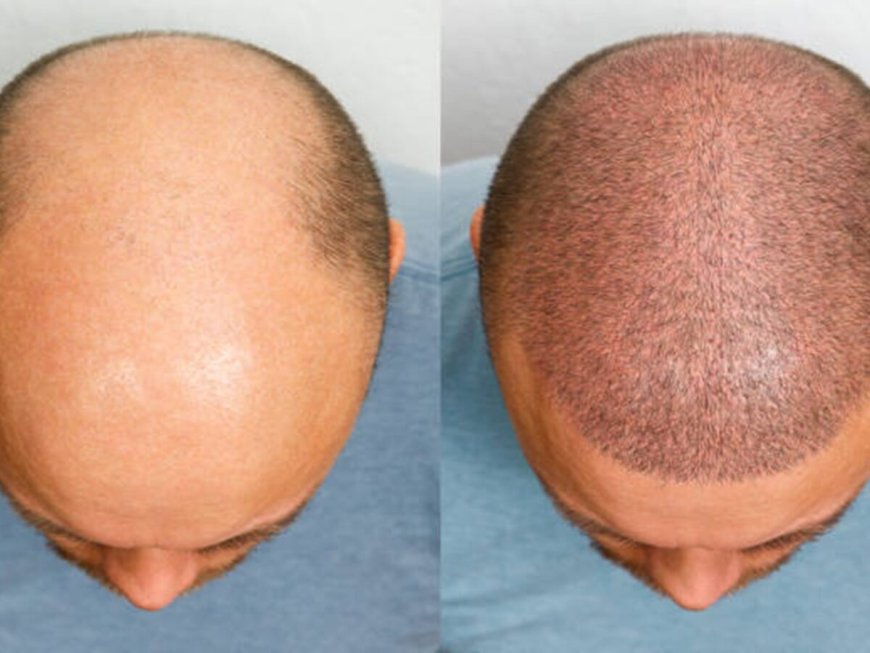 Hair Restoration in Chennai: Reviving Confidence with Every Strand