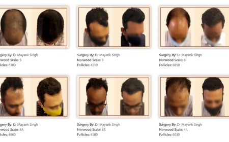 Regenerative & Non‑Surgical Therapies: The Future of Hair Restoration at Crown Hair Transplant Clinic, Delhi