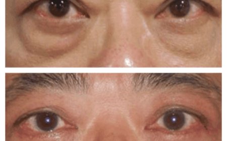 Eye Bag Removal Surgery in Dubai: Recovery and Healing Process