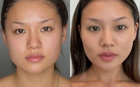 Buccal fat removal Surgery in Dubai and Feminine Facial Contouring