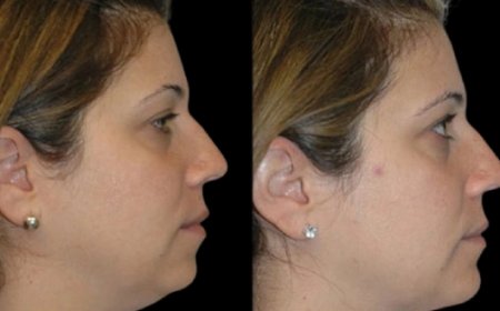 What to Expect During Double Chin Removal Surgery in Dubai