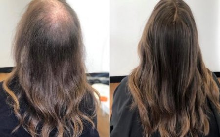 Does Age Affect the Success Rate of Hair Loss Treatment in Dubai?