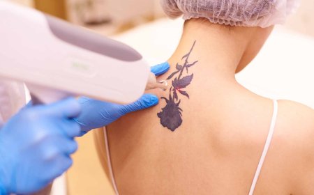 Top Reasons Why Laser Tattoo Removal Is the Best Ink Solution