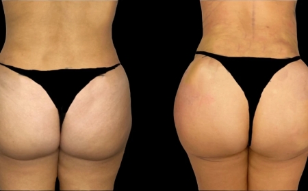 Is Butt Fat Transfer in Dubai Right for You? Key Considerations Before the Procedure