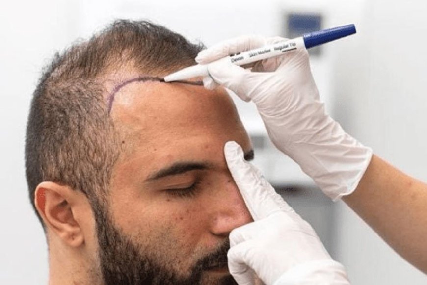 Hair Transplant in Dubai Is the Confidence Spark You Need