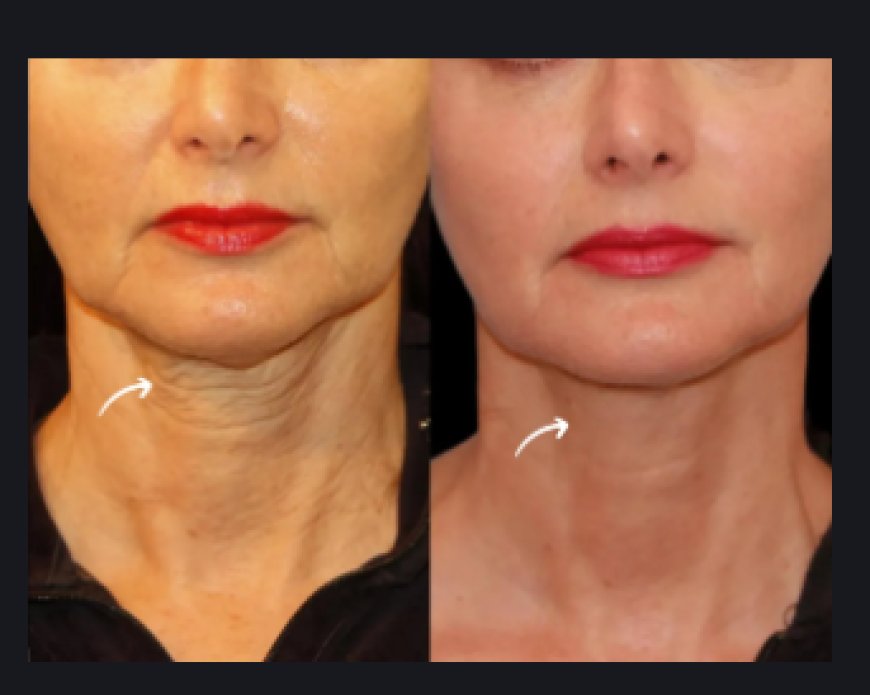 Can Sculptra Fillers Help with Wrinkles? Dubai's Best Plastic Surgeons Explain by Age Group