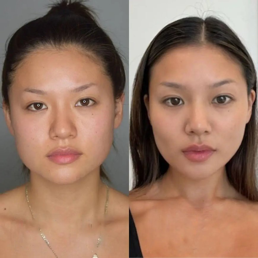 Buccal fat removal Surgery in Dubai and Feminine Facial Contouring