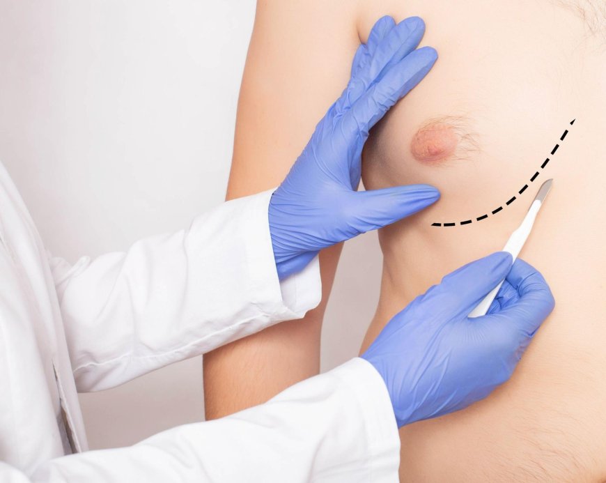 Diet and Lifestyle After Gynecomastia Surgery