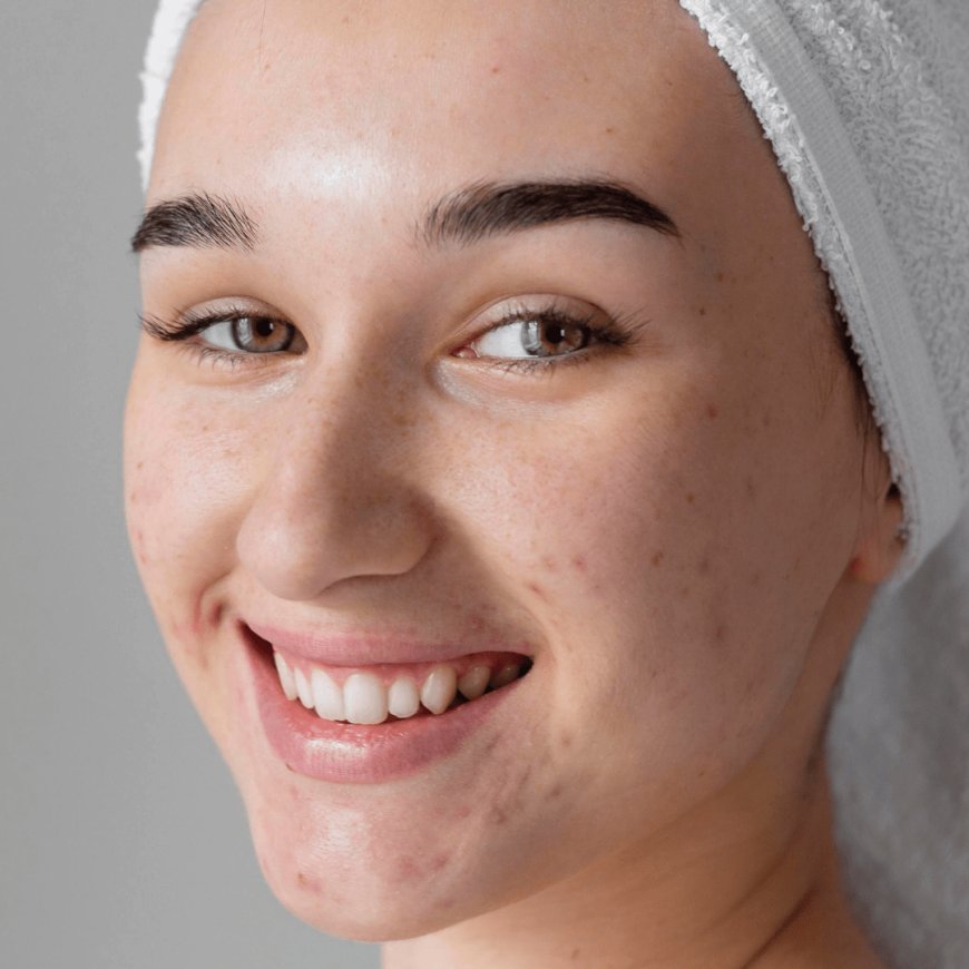 Easy Acne Treatment Solutions for Clearer Skin in Just Days